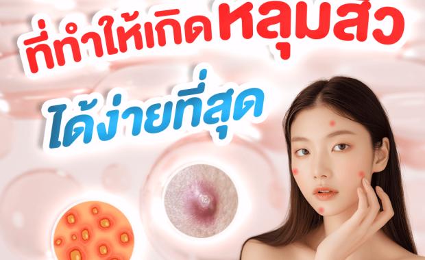 ลักษณะของสิวแบบไหน ที่ทำให้เกิดหลุมสิวได้ง่ายที่สุด